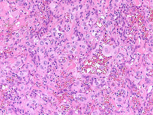 Section of small intestine tumor showing a predominately solid proliferation of large round to polygonal epithelioid cells with abundant eosinophilic cytoplasm, vesicular nuclei, central nucleoli, and frequent mitoses.