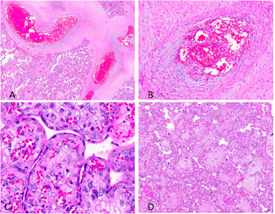 Figure 2. Features of fetal vascular malperfusion in placenta. (A) Vascular ectasia. (B) Vascular thrombus. (C) Villous stromal vascular karyorrhexis. (D) Villous dysmaturity