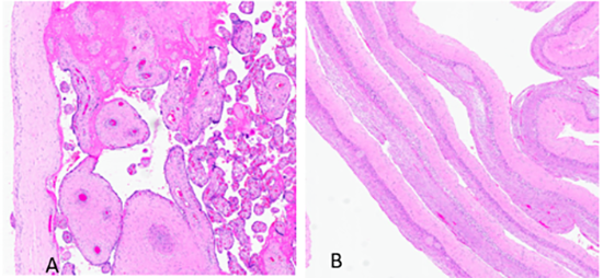 Figure3. Features of amniotic band syndrome in placenta. (A) Absence of the amnion in the fetal membranes. (B) Absence of the amnion in the chorionic plate 