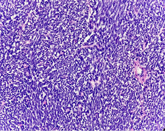 High-grade spindle cell morphology with marked nuclear atypia, hyperchromasia, and prominent nucleoli (High Magnification, 400X).