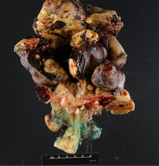 The uterus shows an irregular, nodular contour with serosal disruption by adhesions and tan-white firm tumor nodules. 