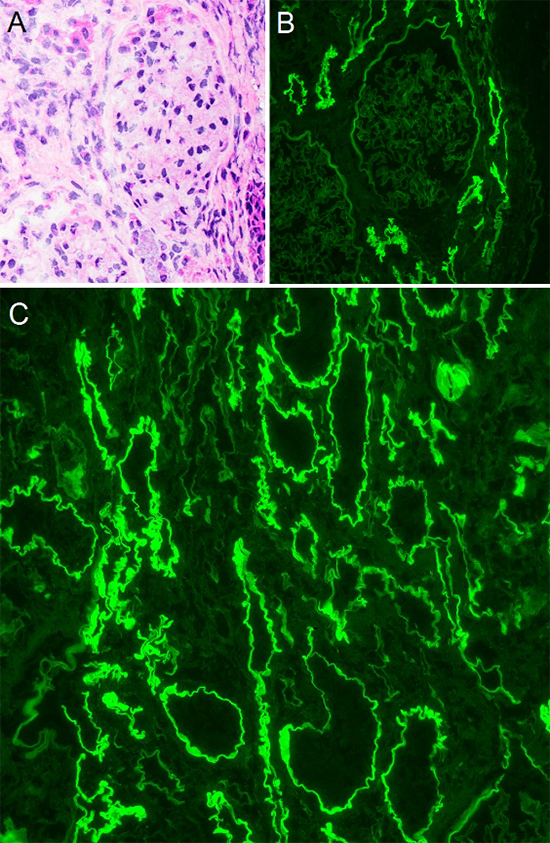 Figure 2: Immunofluorescent findings - (A) H&E stained frozen section showing glomerulus without overt pathologic change. (B) The corresponding field by immunofluorescence shows 4+ linear IgG staining of TBMs with no significant glomerular staining. (C) A separate field with IgG clearly showing 4+ linear staining of TBMs. Note there are tubules which are not staining, likely distal tubules.  TBM: tubular basement membrane