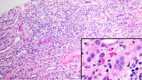 Figure 1A. Light microscopy - (A) H&E stain showing cortical interstitial inflammation composed of lymphocytes and macrophages with few eosinophils and plasma cells (inset).