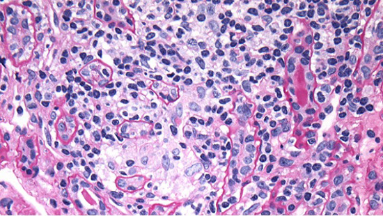 Figure 1B. PAS stain demonstrating atrophic proximal tubules with inflammation (lymphocytes between tubular epithelial cells) and ill-defined granulomatous interstitial inflammation focally, likely secondary to tubular rupture.