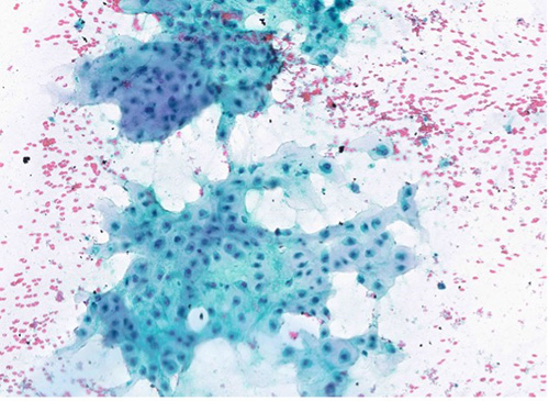 Papanicolaou stain (100X)