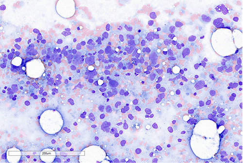 Bone marrow aspirate smear was hypocellular and paucispiculate. In areas with preserved cellularity, large atypical cells with giant pleomorphic nuclei and prominent macronucleoli are identified.