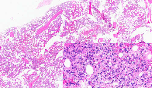 Bone marrow core biopsy showed a packed fibrotic marrow with large atypical lymphoid cells with large pleomorphic nuclei and abundant cytoplasm (shown inset on high-power). Some areas showed a spindled morphology.