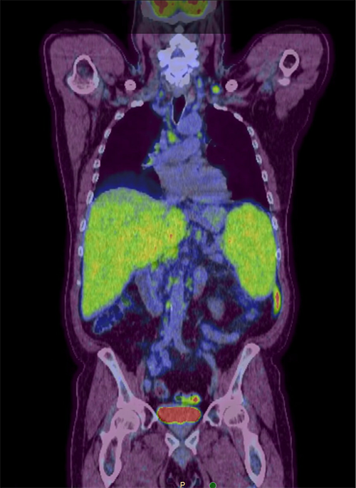 A PET-CT showed Multiple areas of increased activity in supraclavicular lymph nodes bilaterally