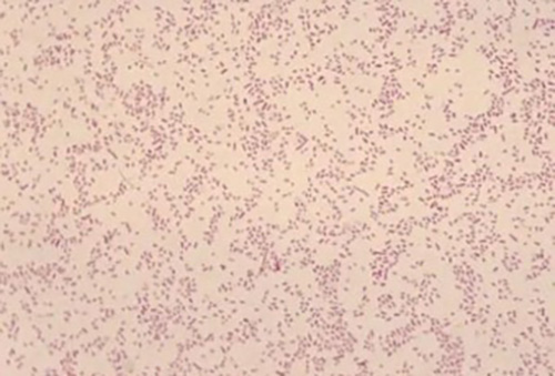 Fig. 1: Gram stain showing the faintly staining gram-negative coccobacilli Brucella melitensis.