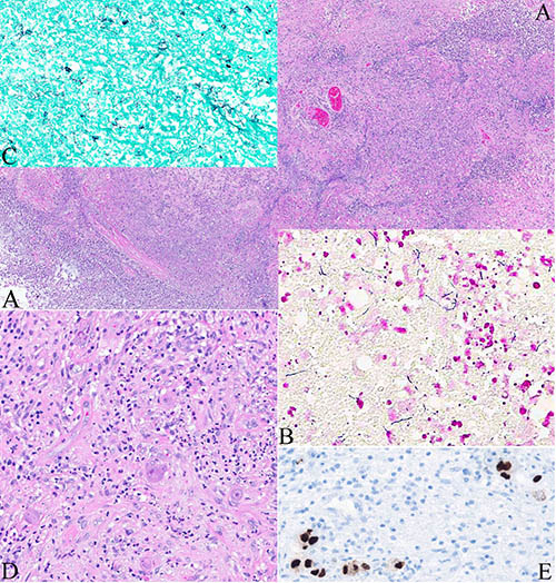 Figure 2. Hematoxylin and eosin (A, D), Gram (B), Grocott's methenamine silver stain (C) and CMV immunostain (D) of the brain lesion. Original magnifications: 100 x (A), 400 x (B & D), 200 x (C & E).